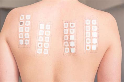 allergy patch test